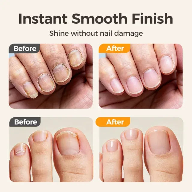Time-Limited Special⏰2-in-1 Smart Electric Nail Trimmer & Polisher for All Ages 👨‍👩‍👧‍👦 – Blade-Free, Blood-Free & Stress-Free Nail Care! 💅